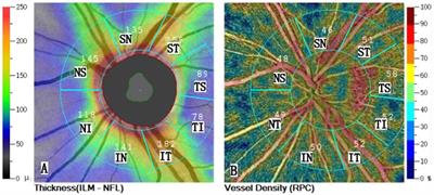 Optical coherence tomography angiography of peripapillary vessel density in non-arteritic anterior ischemic optic neuropathy and demyelinating optic neuritis